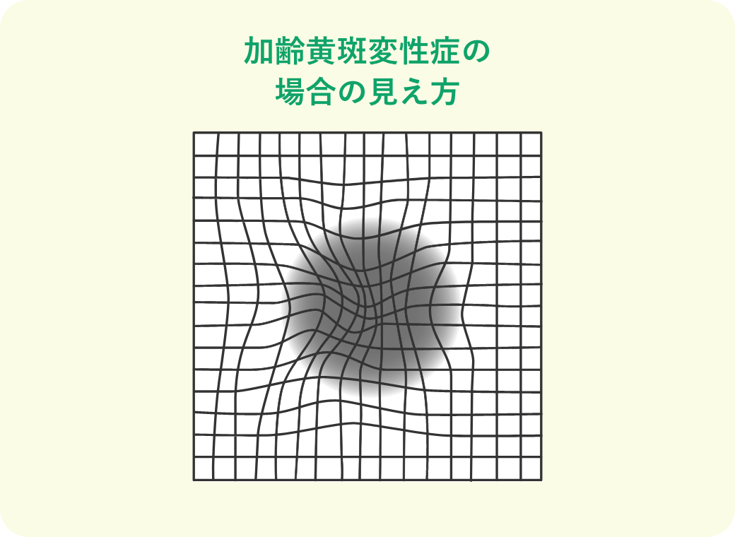 加齢黄斑変性症の場合の見え方