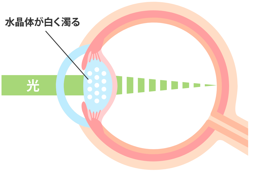 白内障 正常