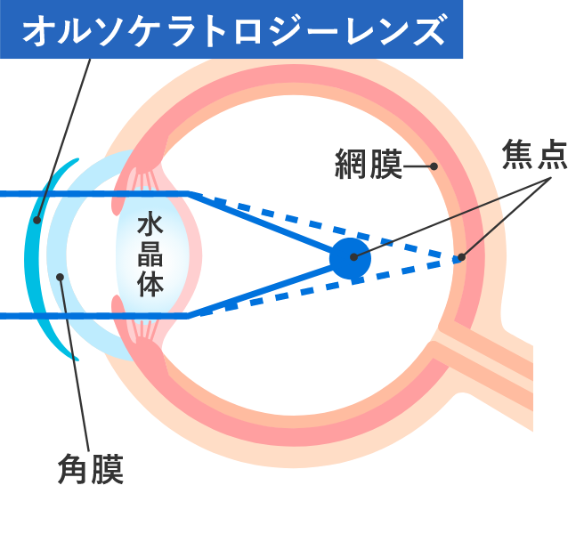 夜：レンズ装用中