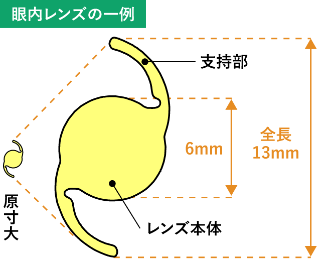 眼内レンズとは？